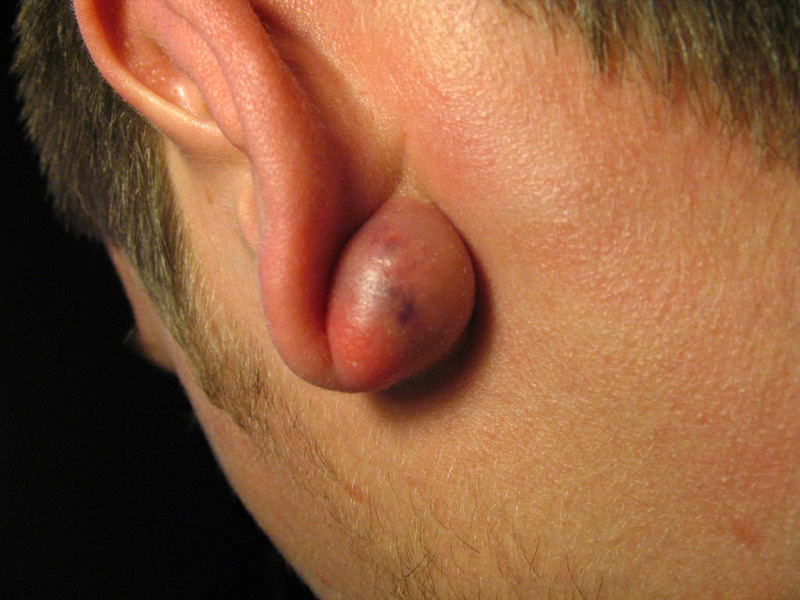 One example of a sebaceous cyst. If you want to see how horribly bad they can get, you can do a Google images search. Photo: Wikimedia Commons
