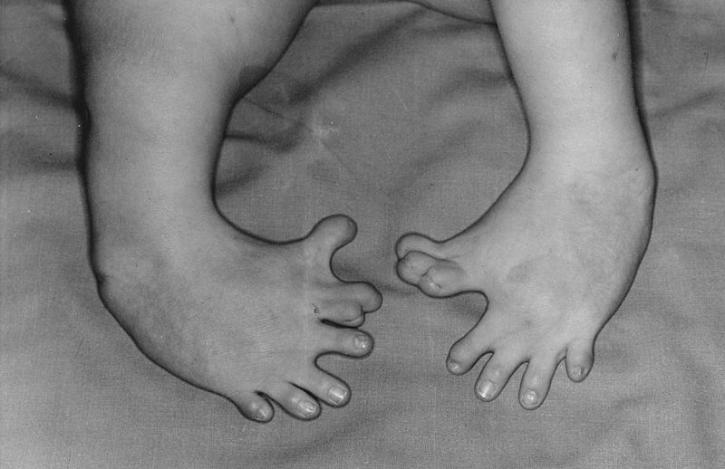 Congenital malformation of the feet. Effects of maternal drugs - thalidomide. Photo: Uploaded to flickr by Otis Historical Archives National Museum of Health and Medicine via Wikimedia Commons